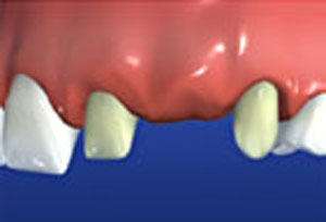 The adjacent teeth are prepared by eliminating tooth structure.