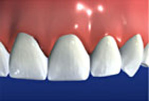 Bridges restore the natural beauty and health of teeth.