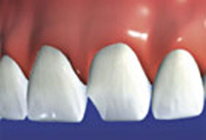Crowns are prescribed for damaged, decayed, or broken teeth