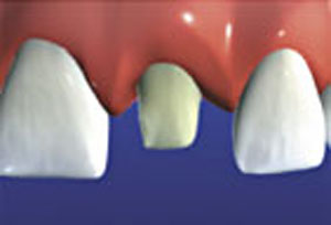 The tooth is prepared by eliminating surface structure