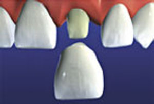 After fabrication the crown is cemented to the prepared tooth
