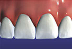 Crowns restore natural beauty and health of teeth