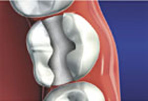 The decayed portion of the tooth is removed from the sound tooth structure.