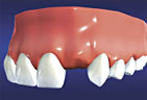 Dental Implants are prescribed to replace a missing tooth or teeth.