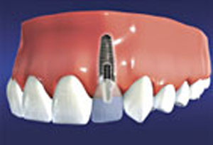 A customized crown or bridge is permanently cemented to the implant.