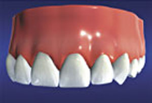 Dental Implants restore the natural beauty, function, and health of teeth.