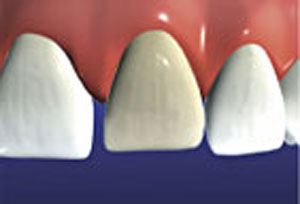 Veneers are prescribed for damaged, discolored, or broken teeth