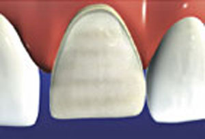 The tooth is prepared by eliminating surface structure.