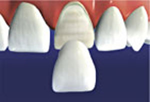 After fabrication the veneer is cemented to the prepared tooth.