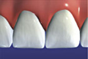 Veneers restore natural beauty and health of teeth.