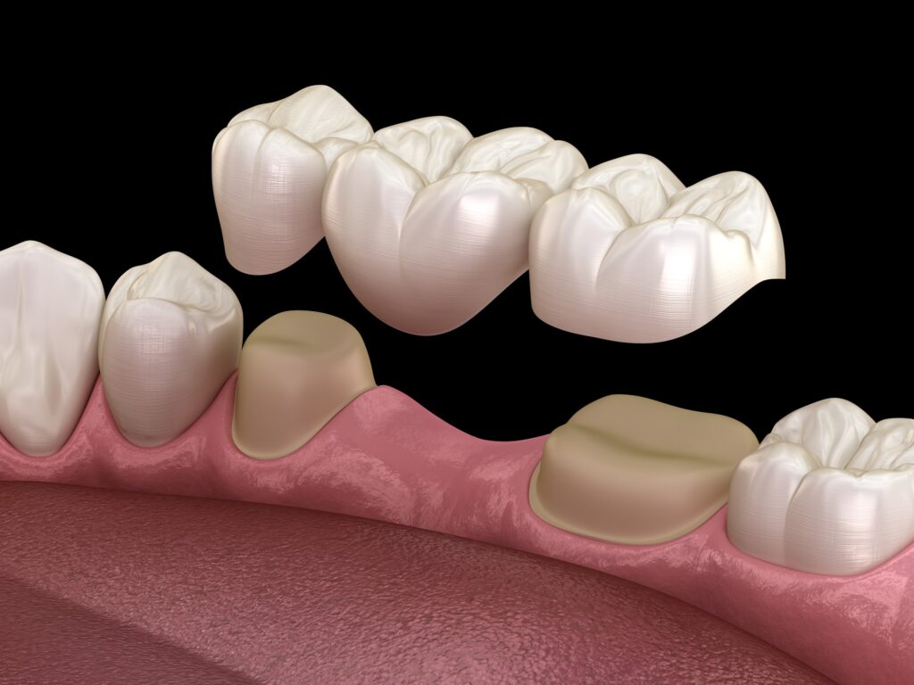 Dental bridge 3D rendering