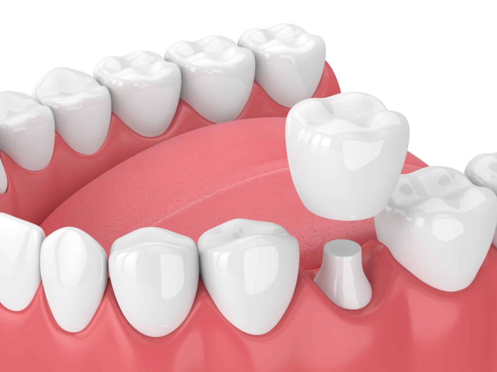 Dental crown restoration