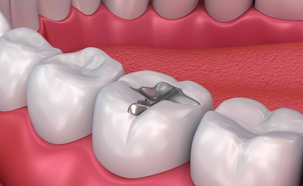 Metal dental filling