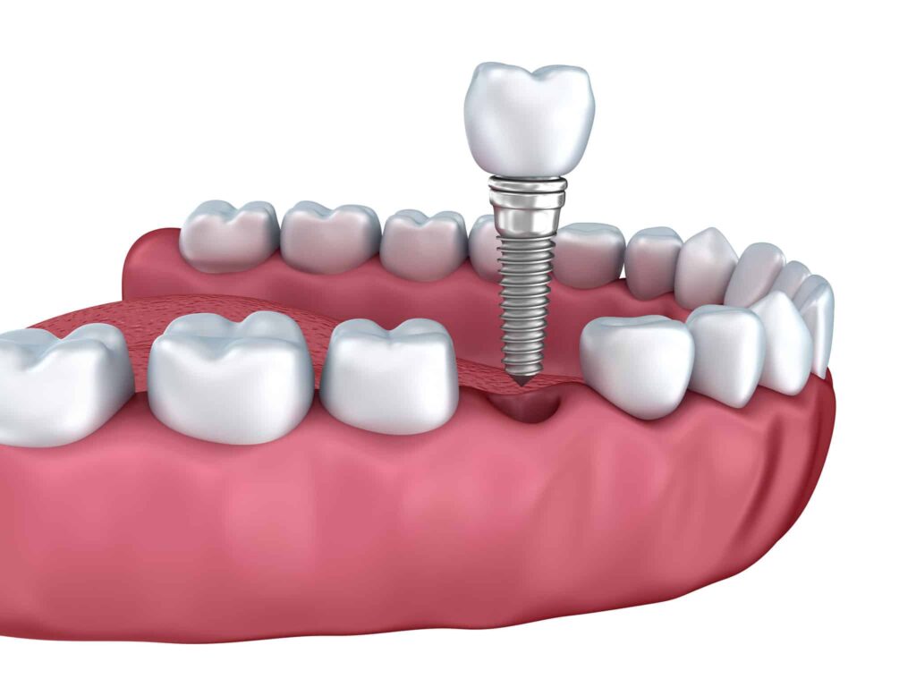 Dental implant model