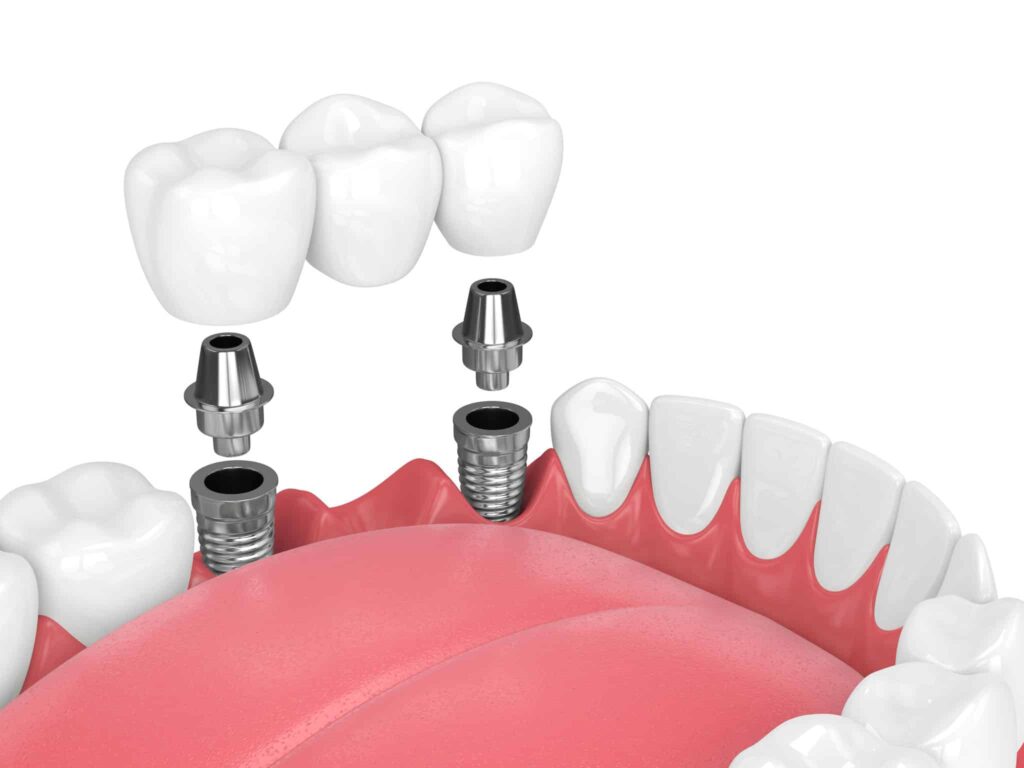 Dental implant illustration