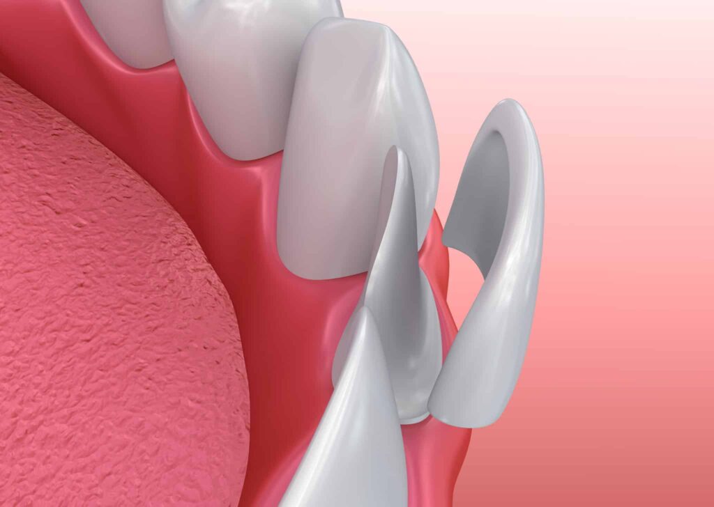 Dental veneer 3D rendering
