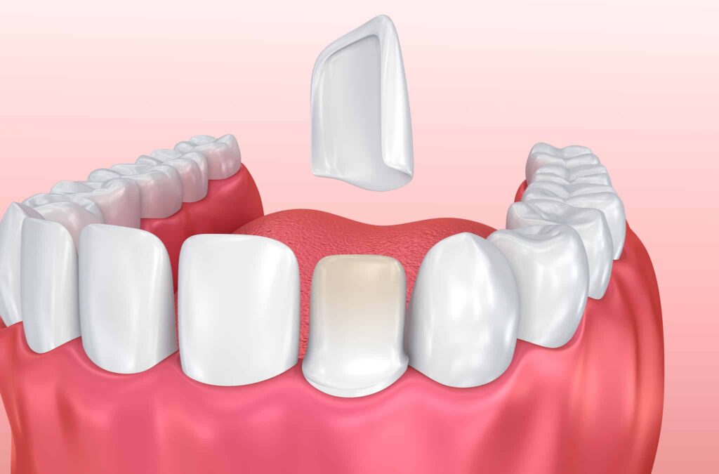 Dental veneer diagram