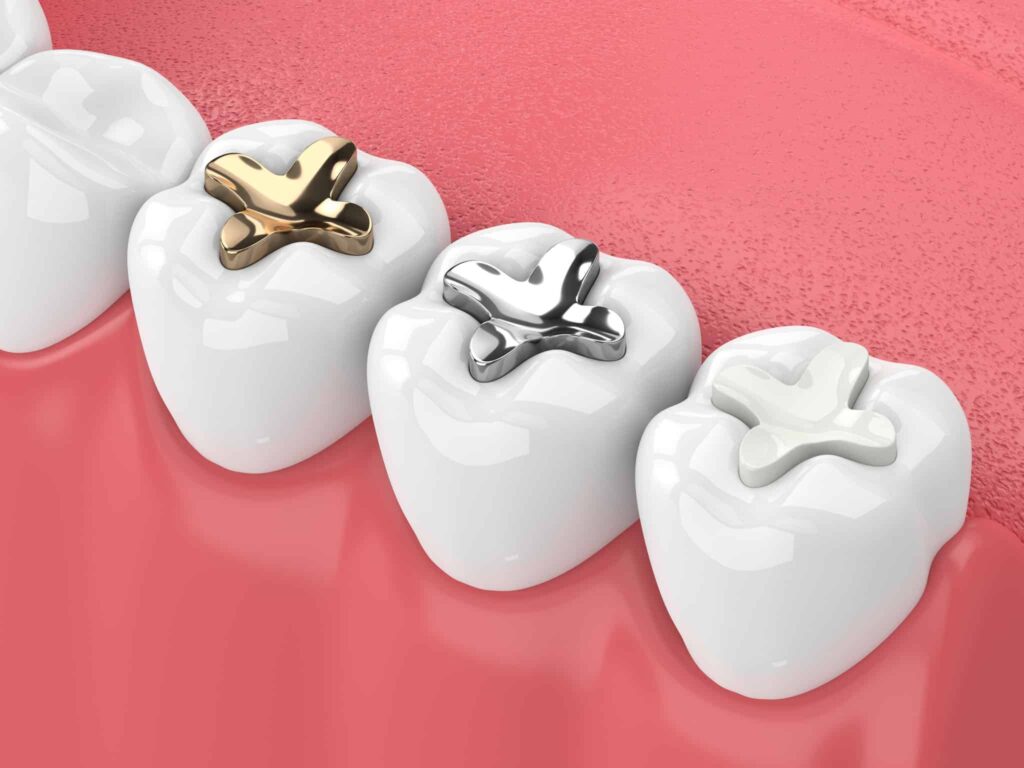 Dental filling color options