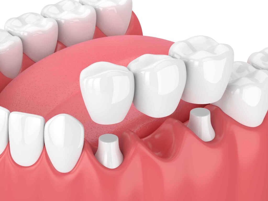 Dental bridge diagram