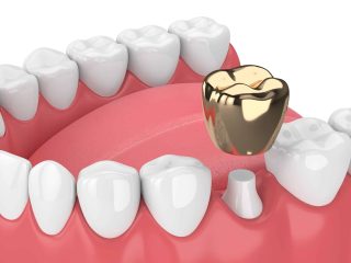 3d render of jaw with dental golden crown filling in gums over white background